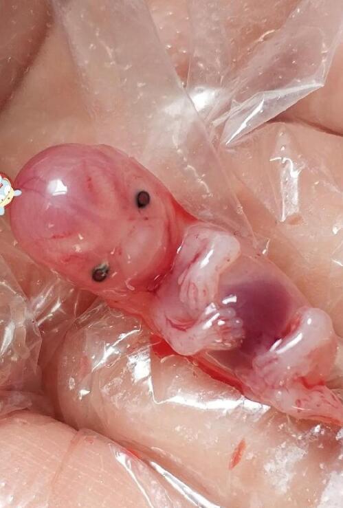 造孽！60天的打胎兒（圖）藥流后引出…他媽的避孕套一萬一只么