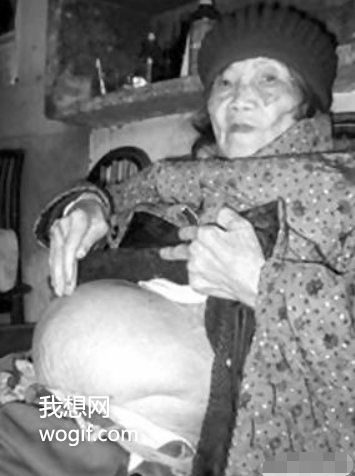 四川一91歲老奶奶不慎摔倒，到醫(yī)院后發(fā)現(xiàn)懷孕了（60年前懷上的）