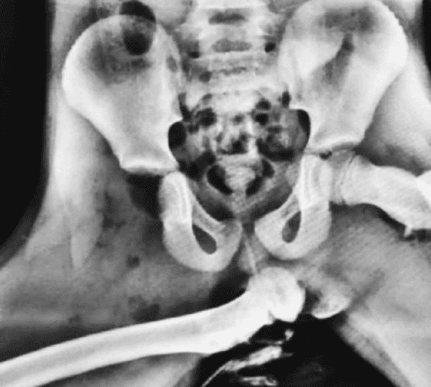 腳放儀表盤上的后果：股骨從下體刺穿，看樣子是女生？