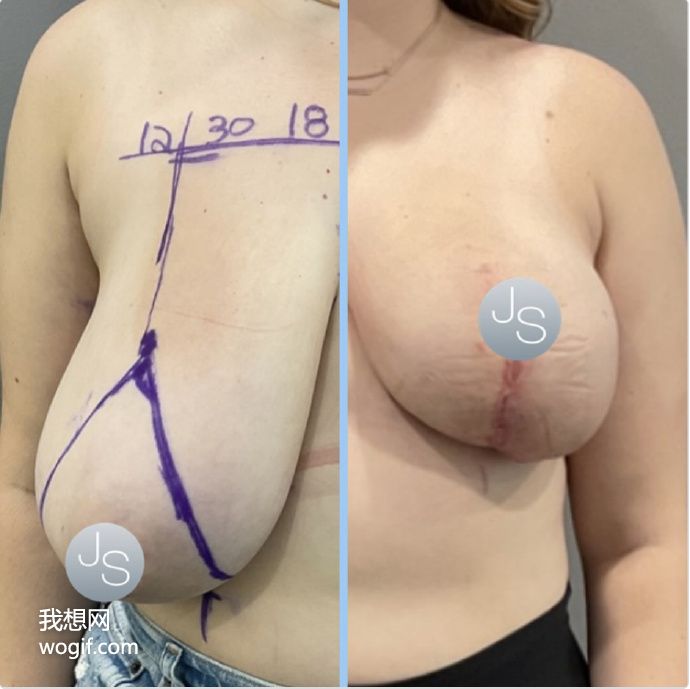乳房縮小切口，生孩子的女生都想做手術(shù)（有圖）