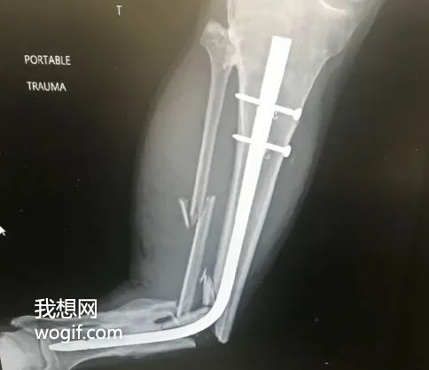 康復期間，再次車禍，體內(nèi)鋼管彎了（圖）